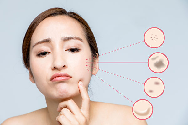 臉上長斑的種類常見有老人斑、雀斑、肝斑和發炎後的色素沉澱。